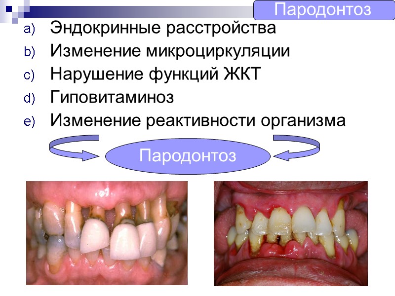 Эндокринные расстройства Изменение микроциркуляции Нарушение функций ЖКТ Гиповитаминоз Изменение реактивности организма Пародонтоз Пародонтоз